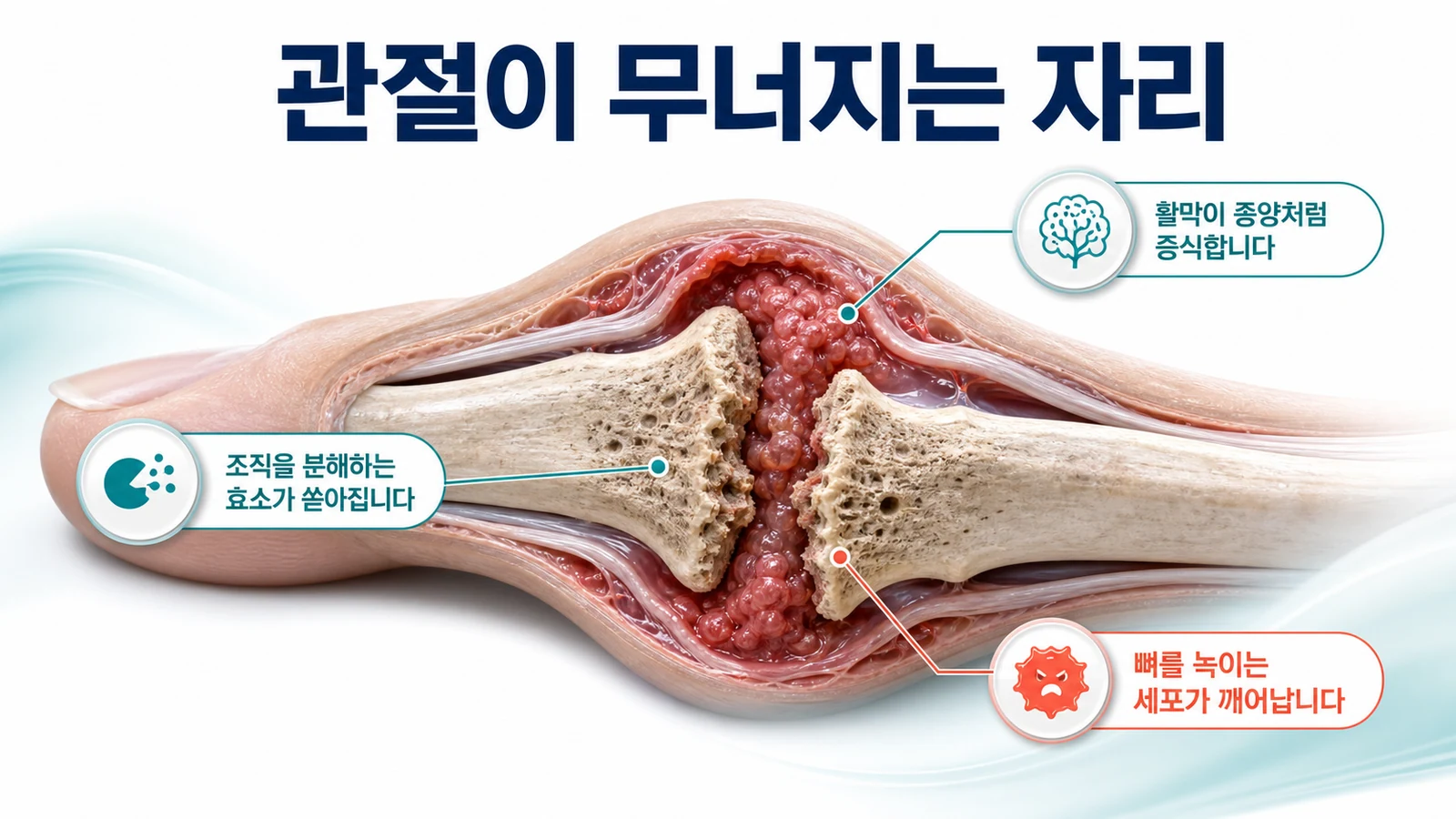 손가락 관절 단면에서 활막이 종양처럼 증식하고 조직 분해 효소가 쏟아지며 뼈를 녹이는 세포가 깨어나는 과정을 표시한 도식