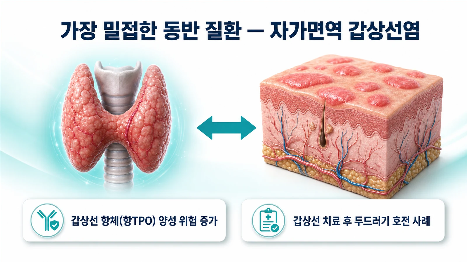 만성 두드러기와 자가면역 갑상선염의 연관성을 설명하는 인포그래픽
