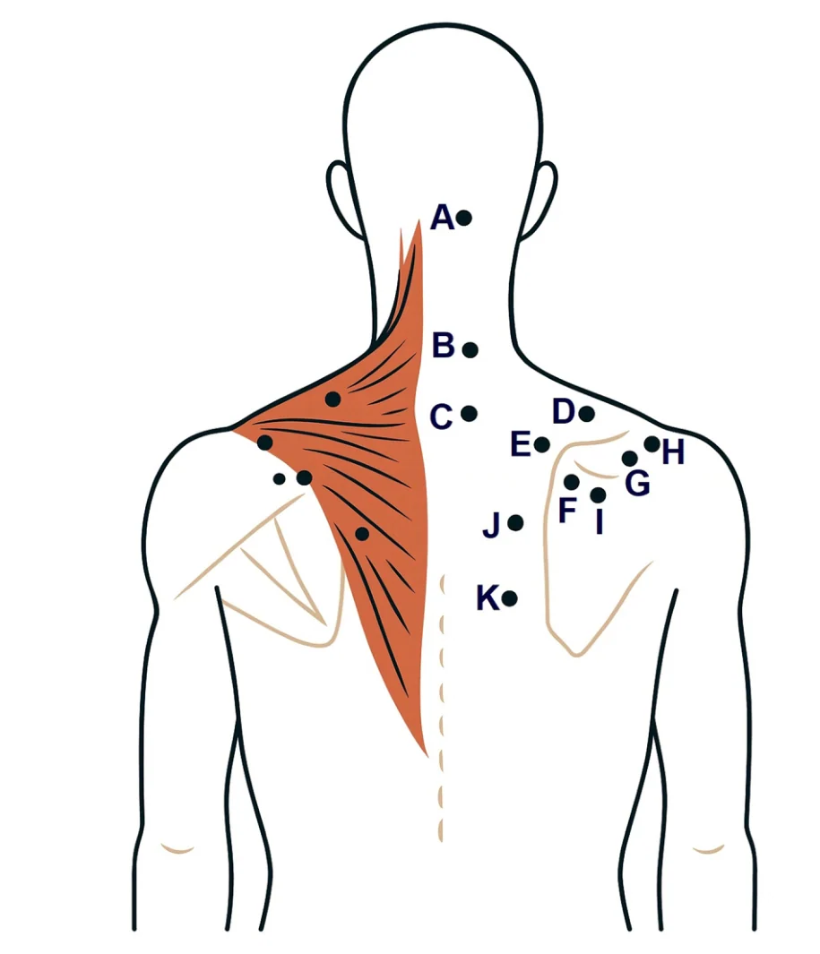 승모근(어깨·목)의 압력통증 민감도 측정점 지도(논문 원문)