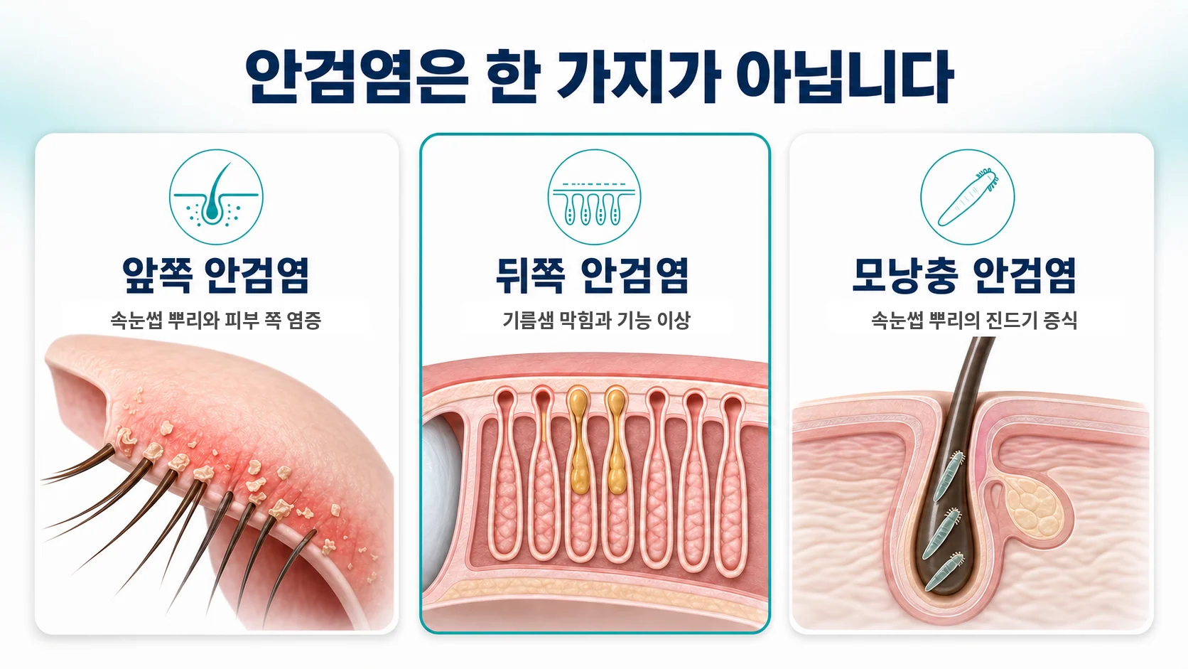 안검염의 세 가지 형태를 앞쪽, 뒤쪽, 모낭충으로 나눠 설명한 비교 도식