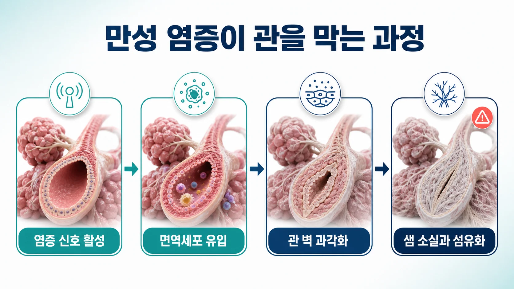 만성 염증이 기름샘 관을 막고 섬유화로 이어지는 네 단계 도식