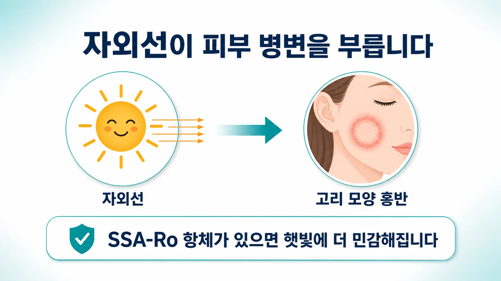 자외선이 SSA-Ro 항체가 있는 피부에 고리 모양 홍반을 부르는 과정