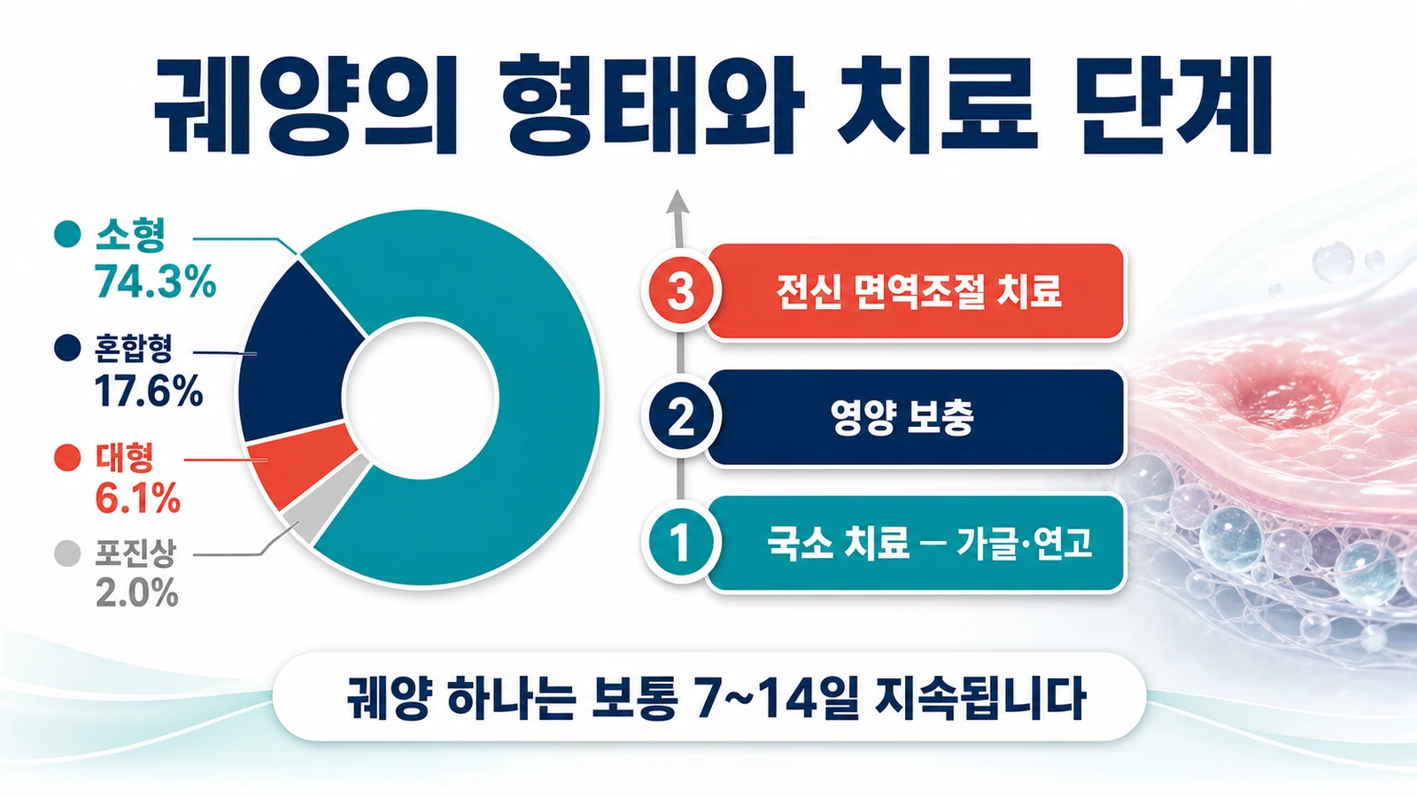 소형·대형·포진상 궤양의 형태별 비율과 단계적 치료 흐름을 정리한 인포그래픽
