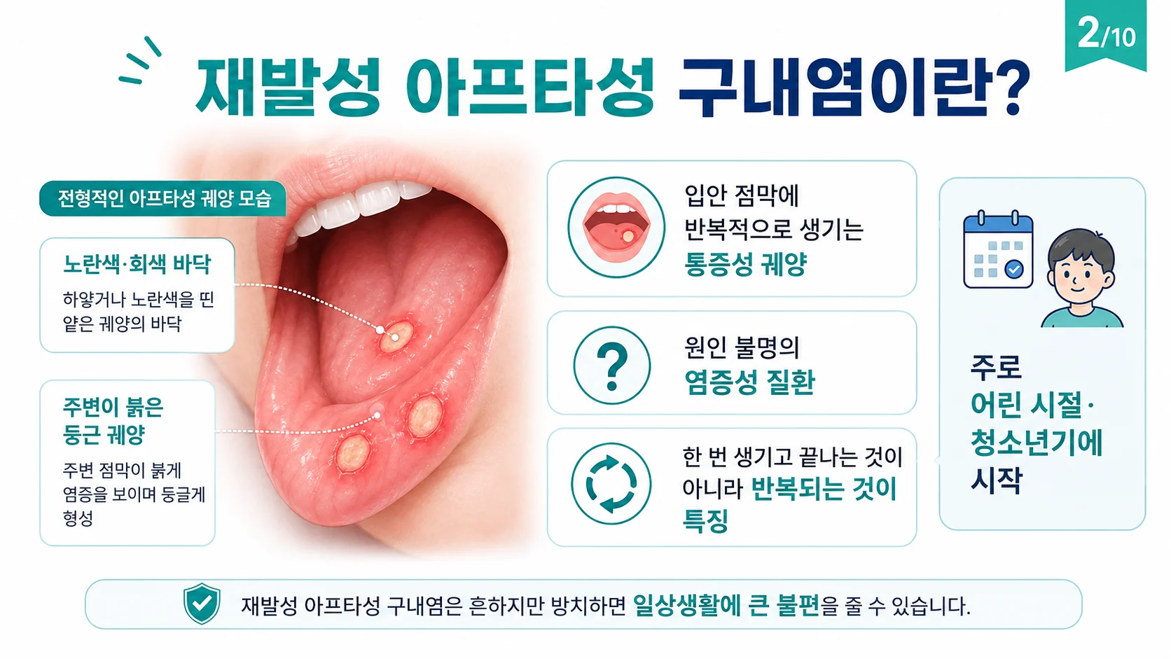 재발성 아프타성 구내염이란 — 입안 점막의 반복성 통증 궤양