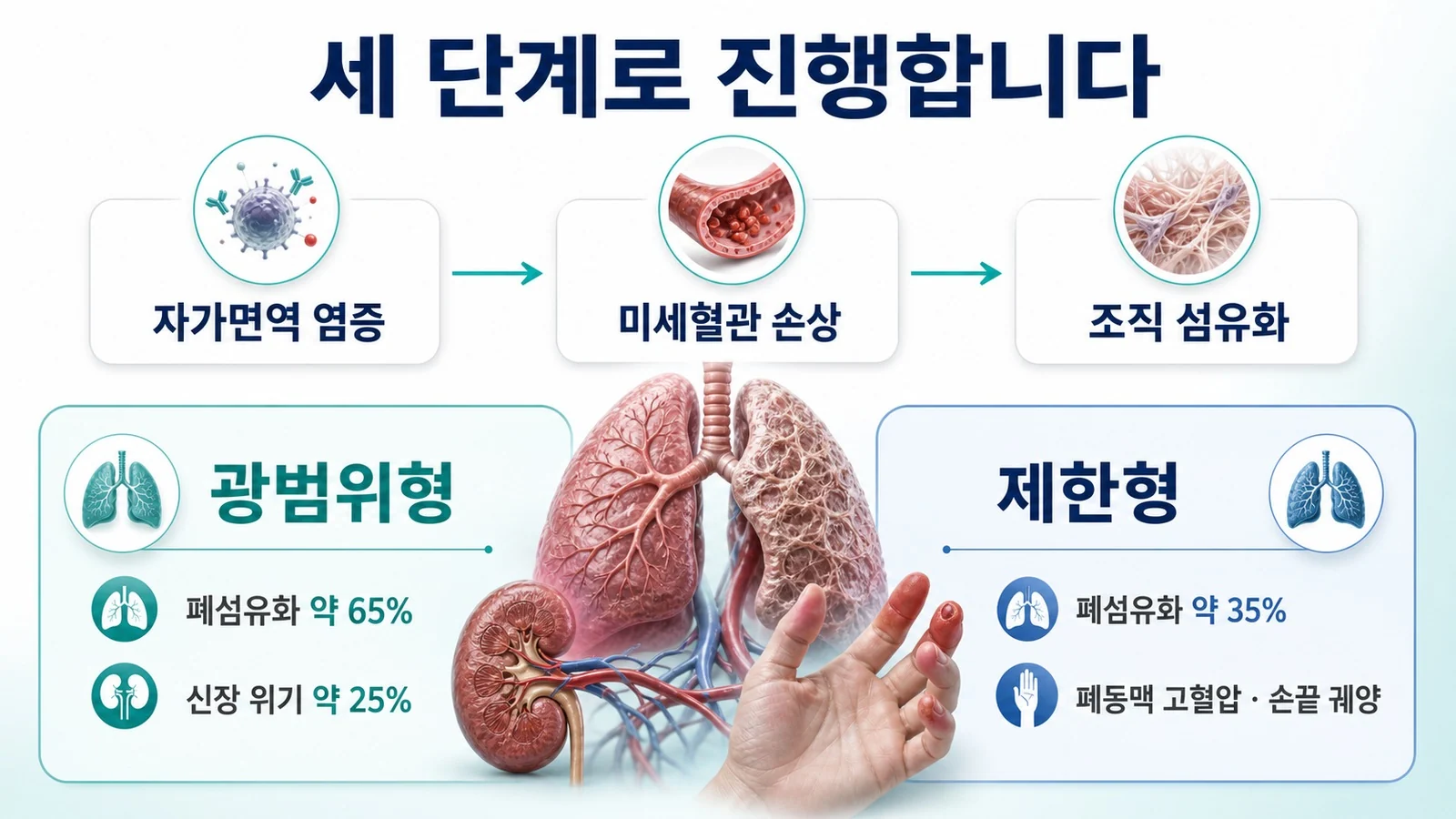 면역 염증에서 미세혈관 손상을 거쳐 섬유화로 이어지는 세 단계와 광범위형·제한형의 차이를 정리한 도식