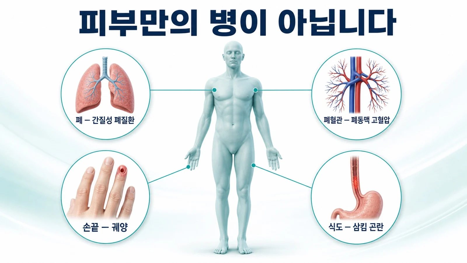 폐의 간질성 변화와 폐동맥 고혈압, 손끝 궤양과 식도 문제까지 이 병이 침범하는 장기를 표시한 이미지