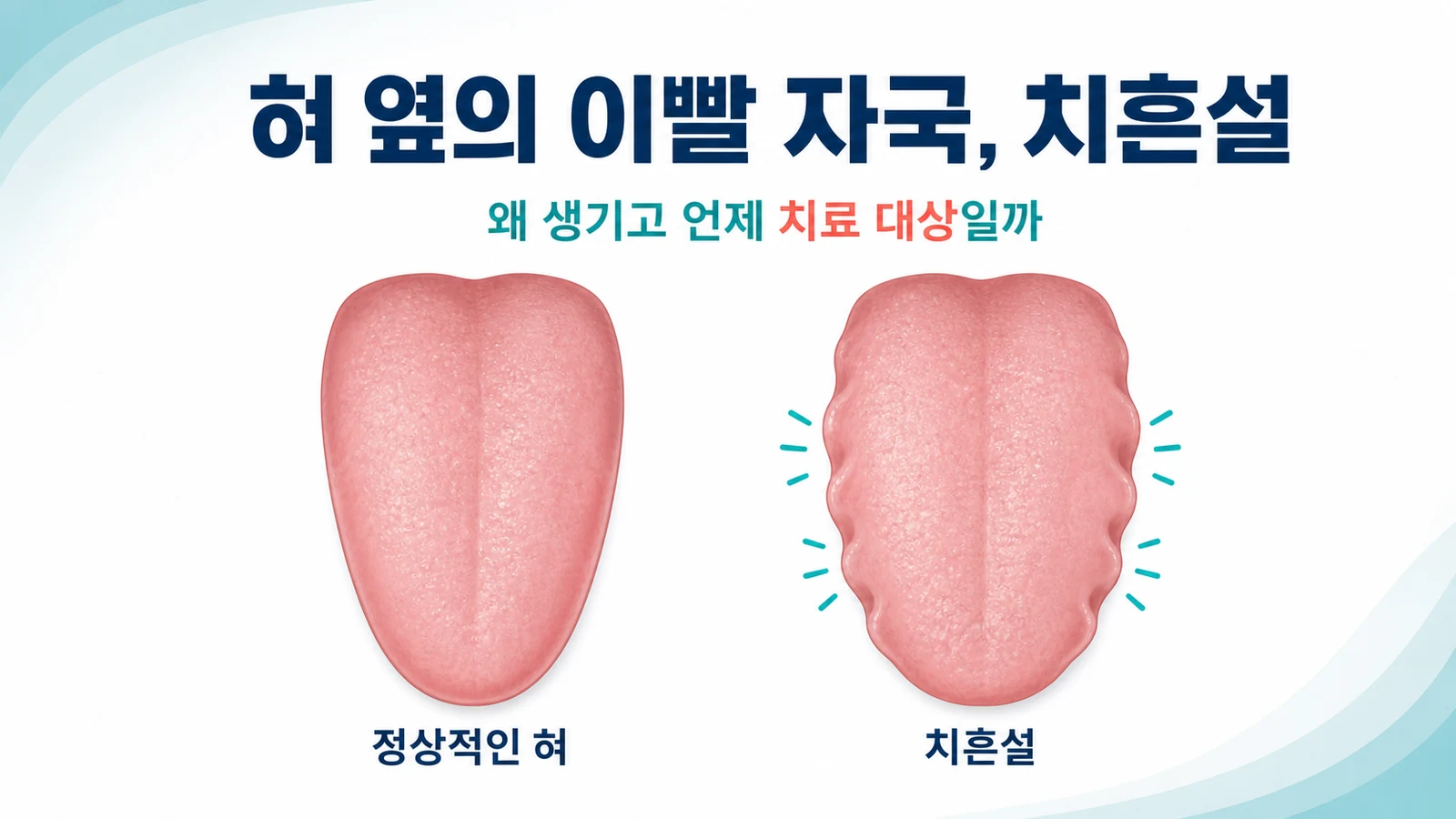 정상적인 혀와 옆면에 물결 모양 자국이 있는 치흔설을 비교한 그림