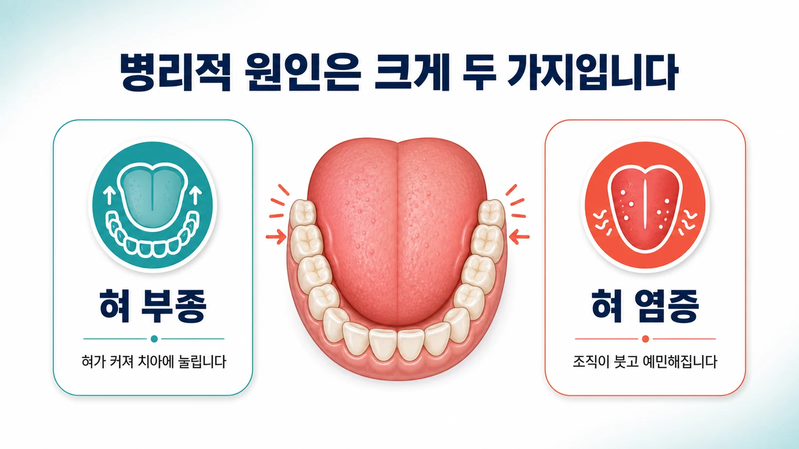 혀 부종과 혀 염증이라는 두 가지 병리적 원인을 나타낸 그림