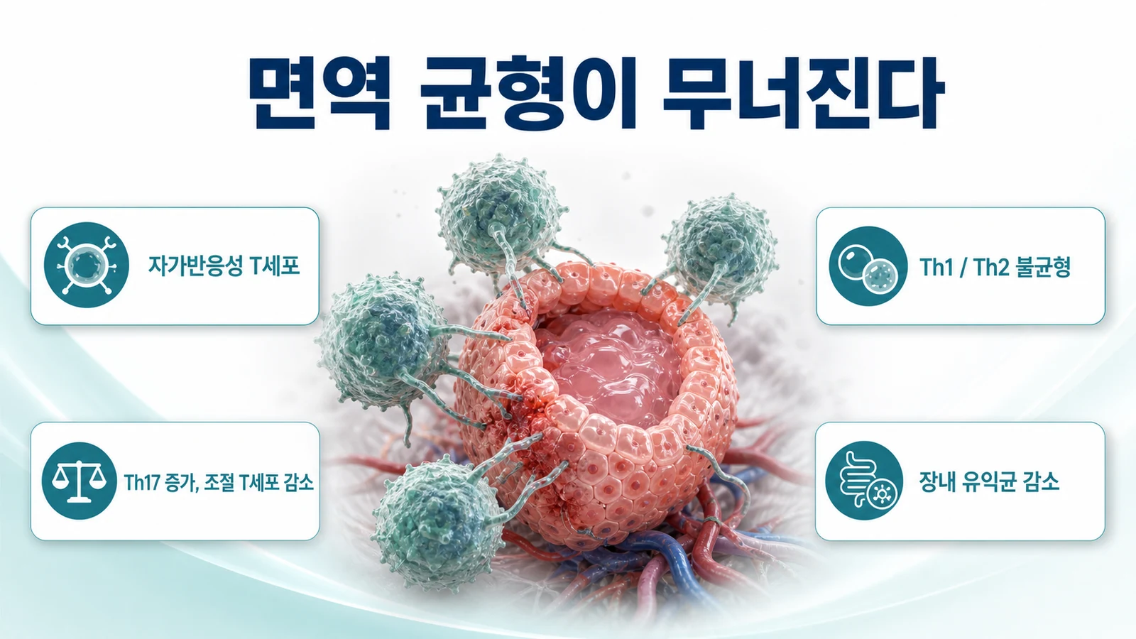 면역 균형 붕괴를 설명하는 인포그래픽. 조절 T세포와 Th17 세포의 균형, 장내 미생물 변화가 갑상선 여포세포 파괴로 이어지는 과정