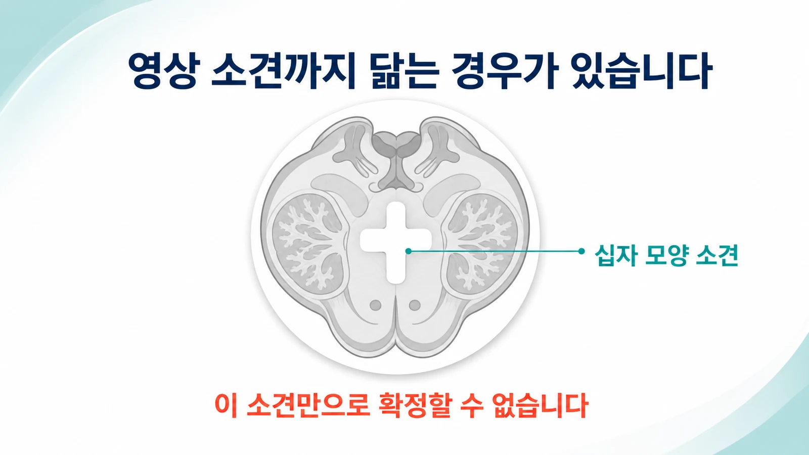 뇌교의 십자 모양 소견이 다계통위축증에만 특이적이지 않음을 나타낸 개념도