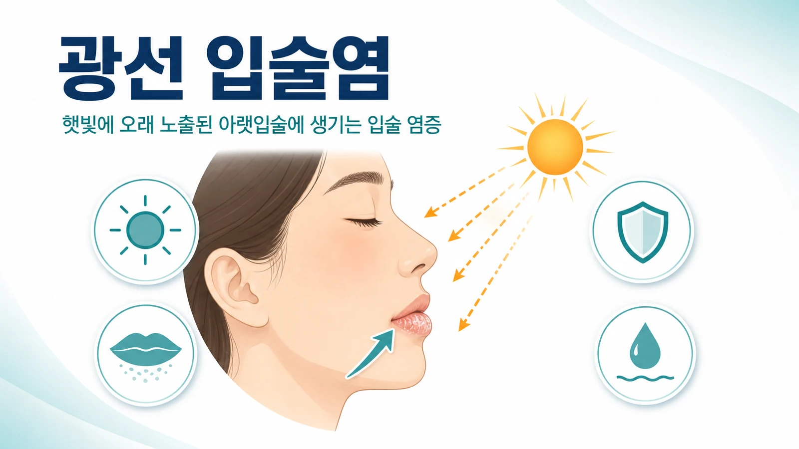 햇빛에 노출된 아랫입술에 생기는 광선 입술염을 나타낸 그림