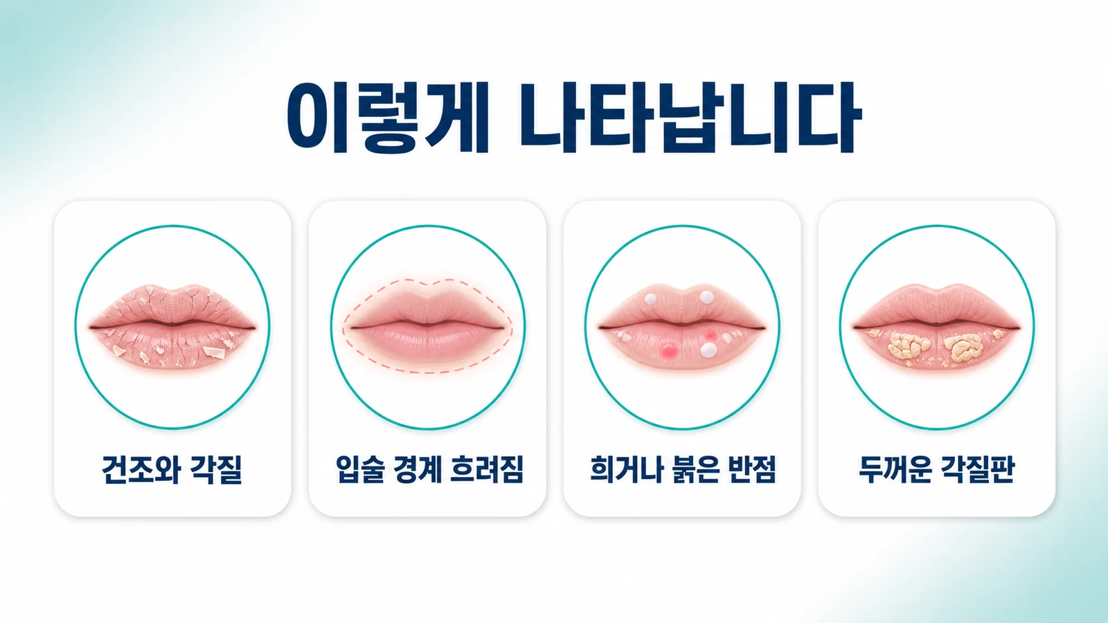 건조와 각질, 입술 경계 흐려짐, 흰색이나 붉은 반점, 두꺼운 각질판 등 광선 입술염의 모습