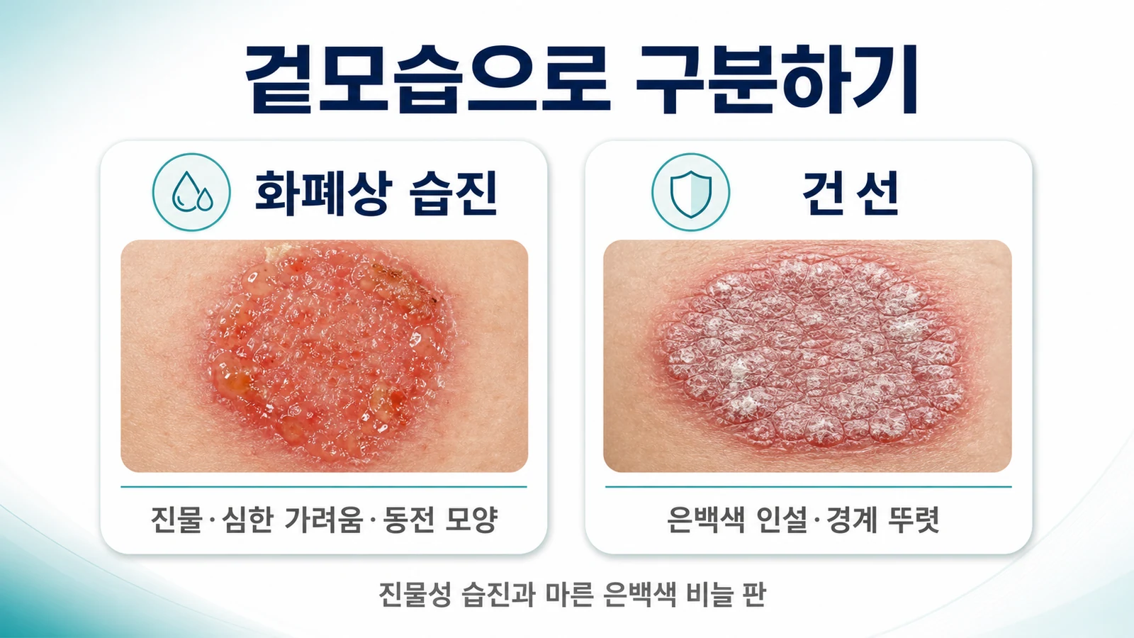 화폐상 습진의 동전 모양 진물성 병변과 건선의 은백색 인설 판을 나란히 비교한 이미지