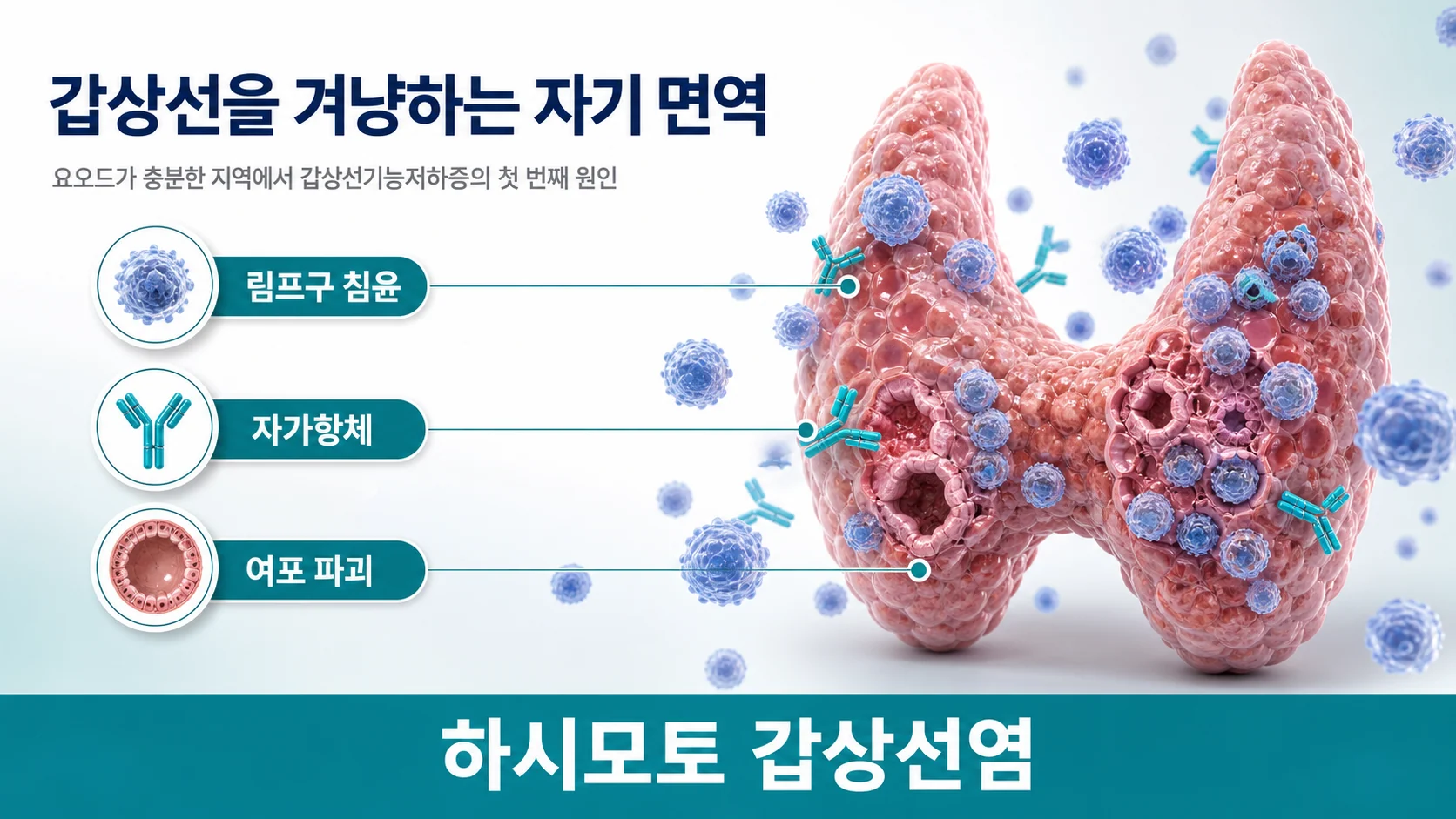 갑상선기능 저하증의 주요 원인 하시모토 갑상선염