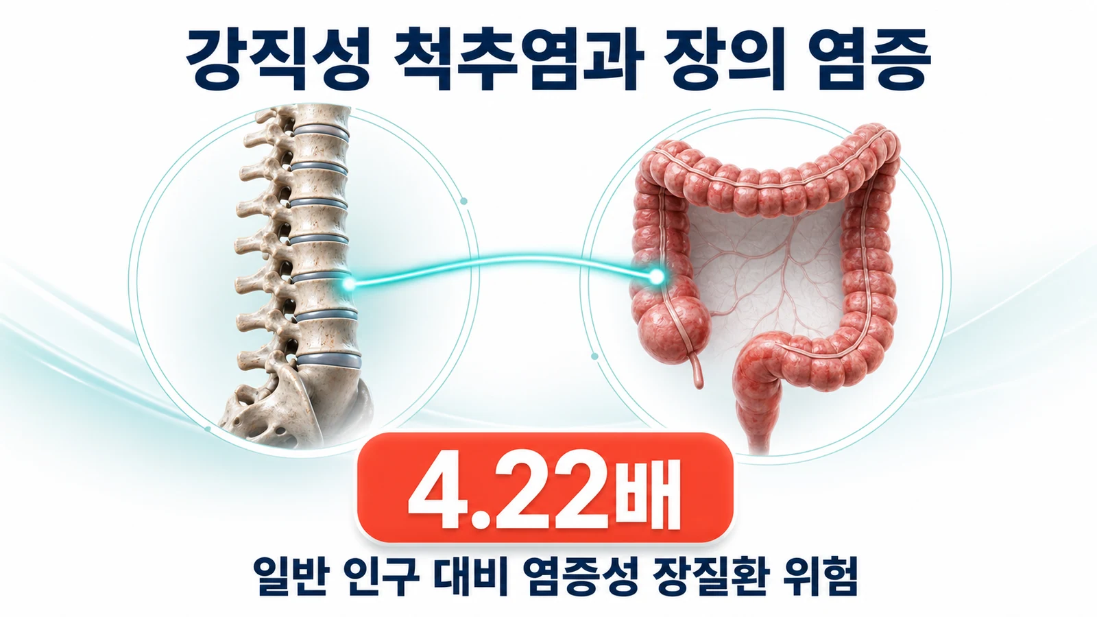 강직성 척추염과 염증성 장질환 — 장 증상을 과민성 대장증후군으로만 넘기면 안 되는 이유