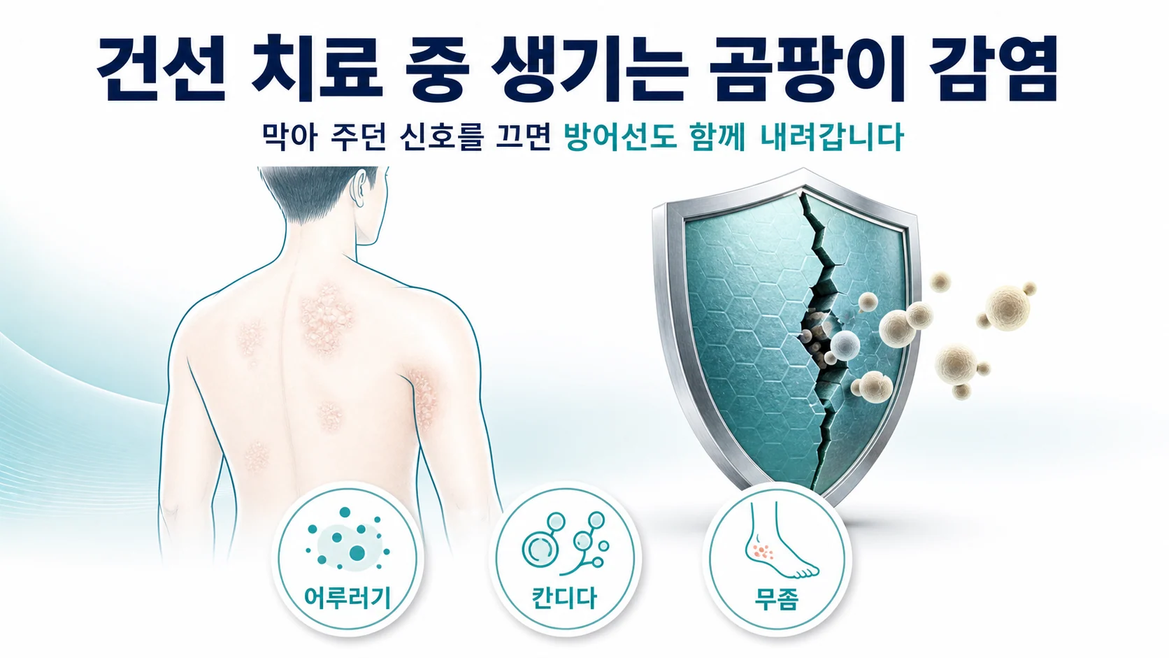 건선 치료 중 발생하는 어루러기 칸디다 감염증 원인은?