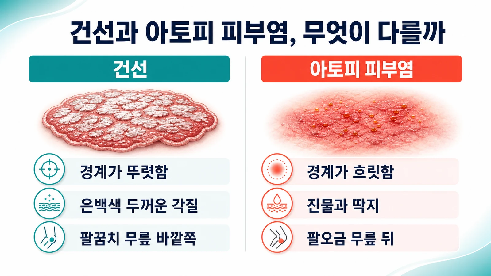 건선과 아토피 피부염의 차이 — 감별 포인트와 자가면역 염증의 관여