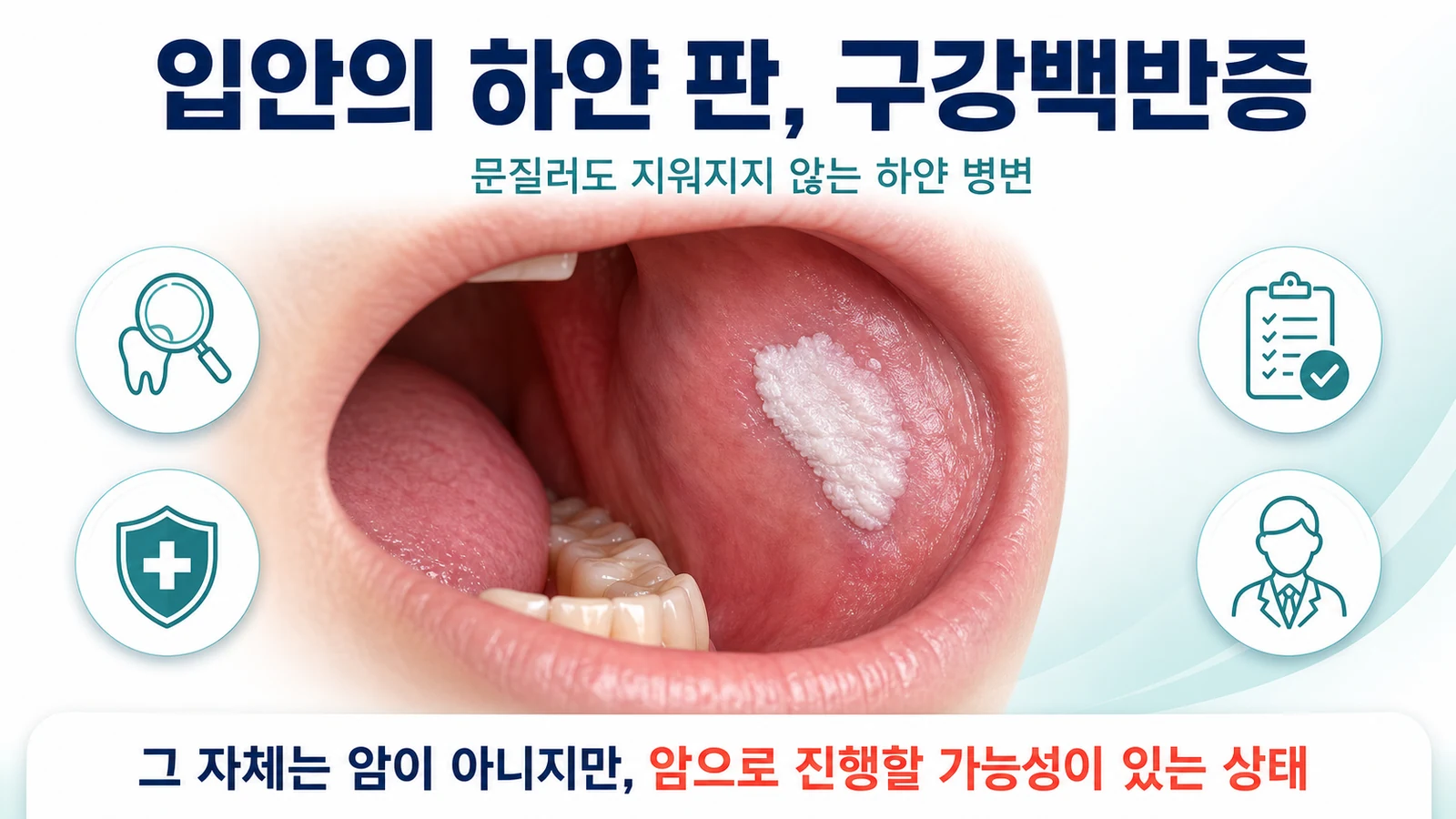 구강백반증은 왜 암으로 진행할까 — 암의 특징 발현으로 본 위험 예측