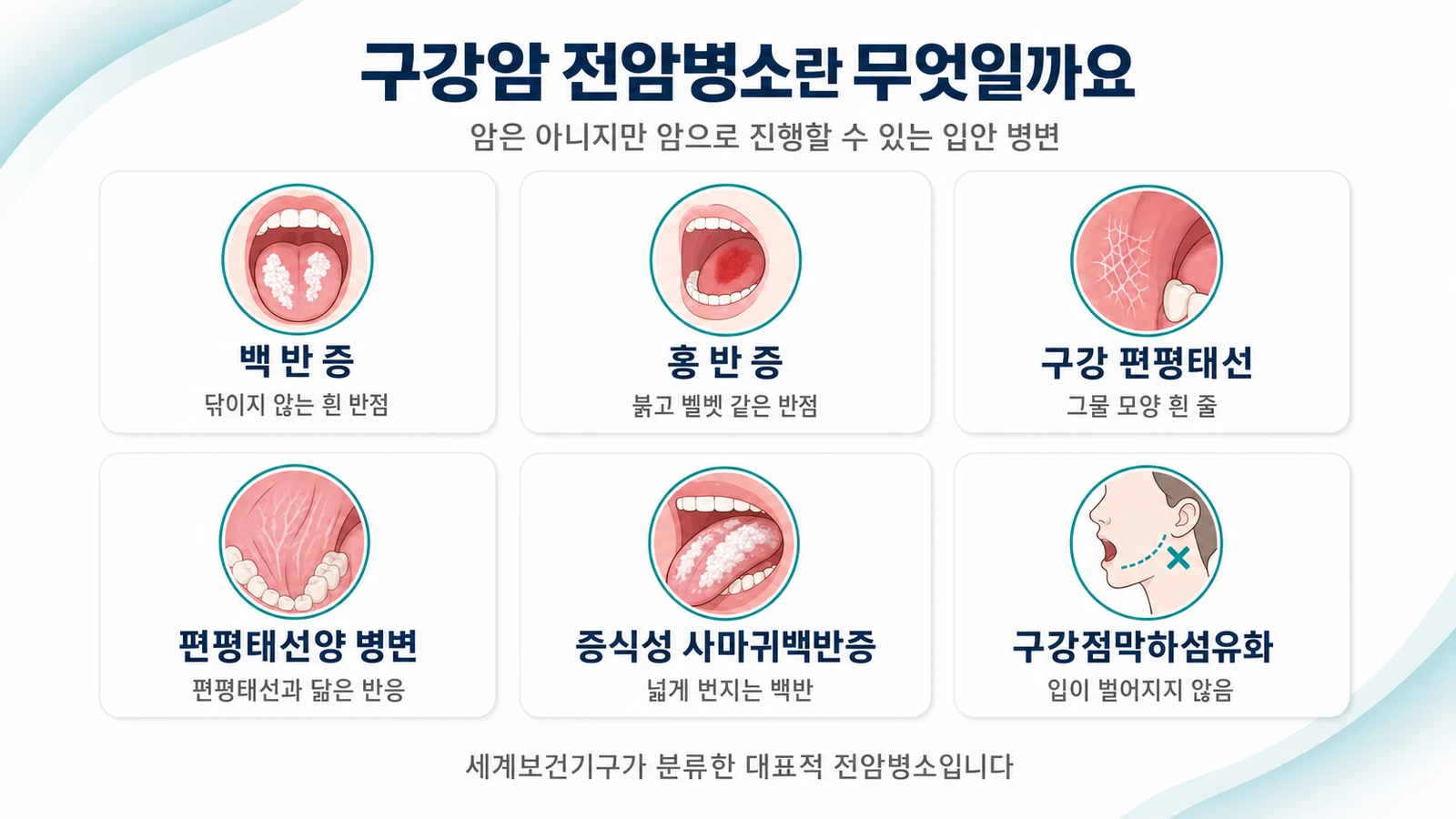 구강암 전암병소란 무엇일까 — 백반증·편평태선·홍반증의 암 진행 위험