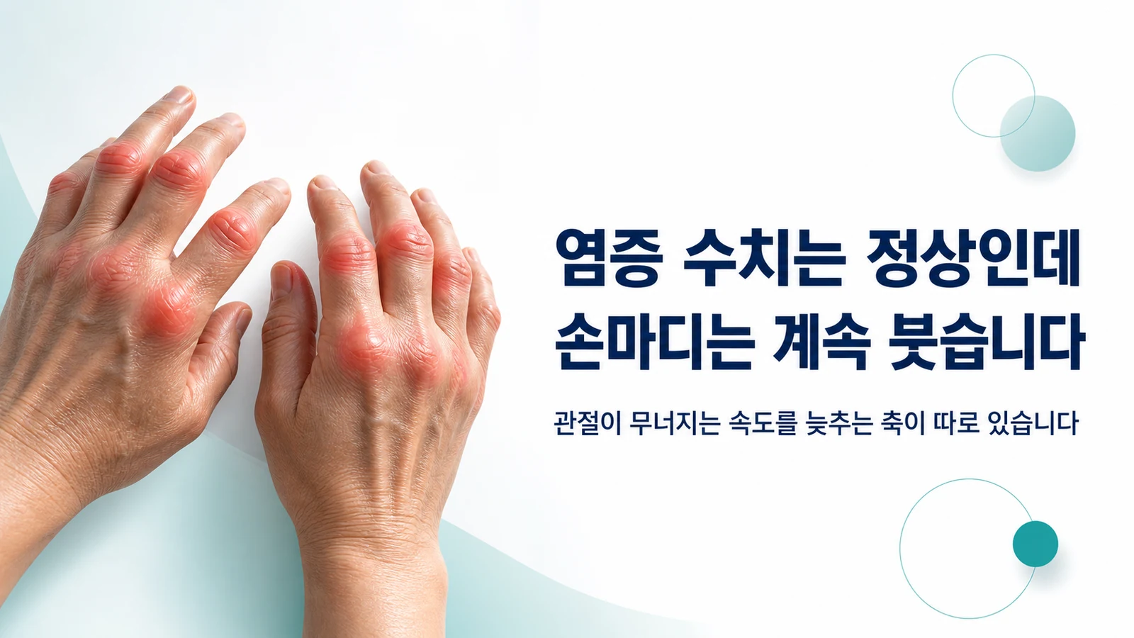 류마티스 관절염 치료 한의원 - 관절이 무너지는 속도를 늦춰야 합니다