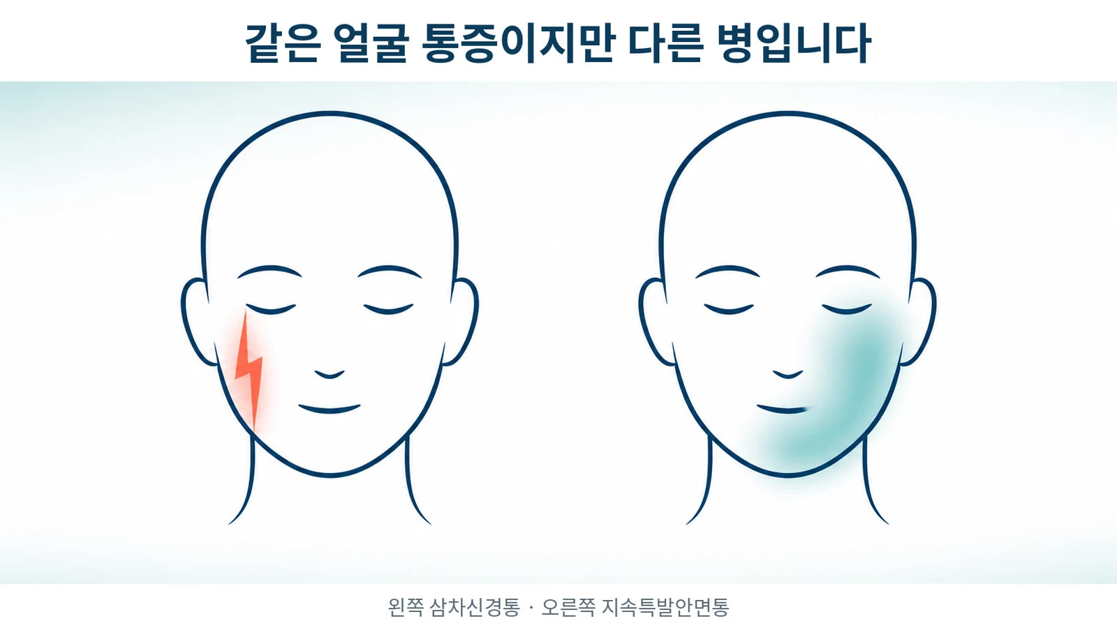 삼차신경통과 지속특발안면통, 무엇이 다른가 — 임상·병리·치료와 한의학 근거