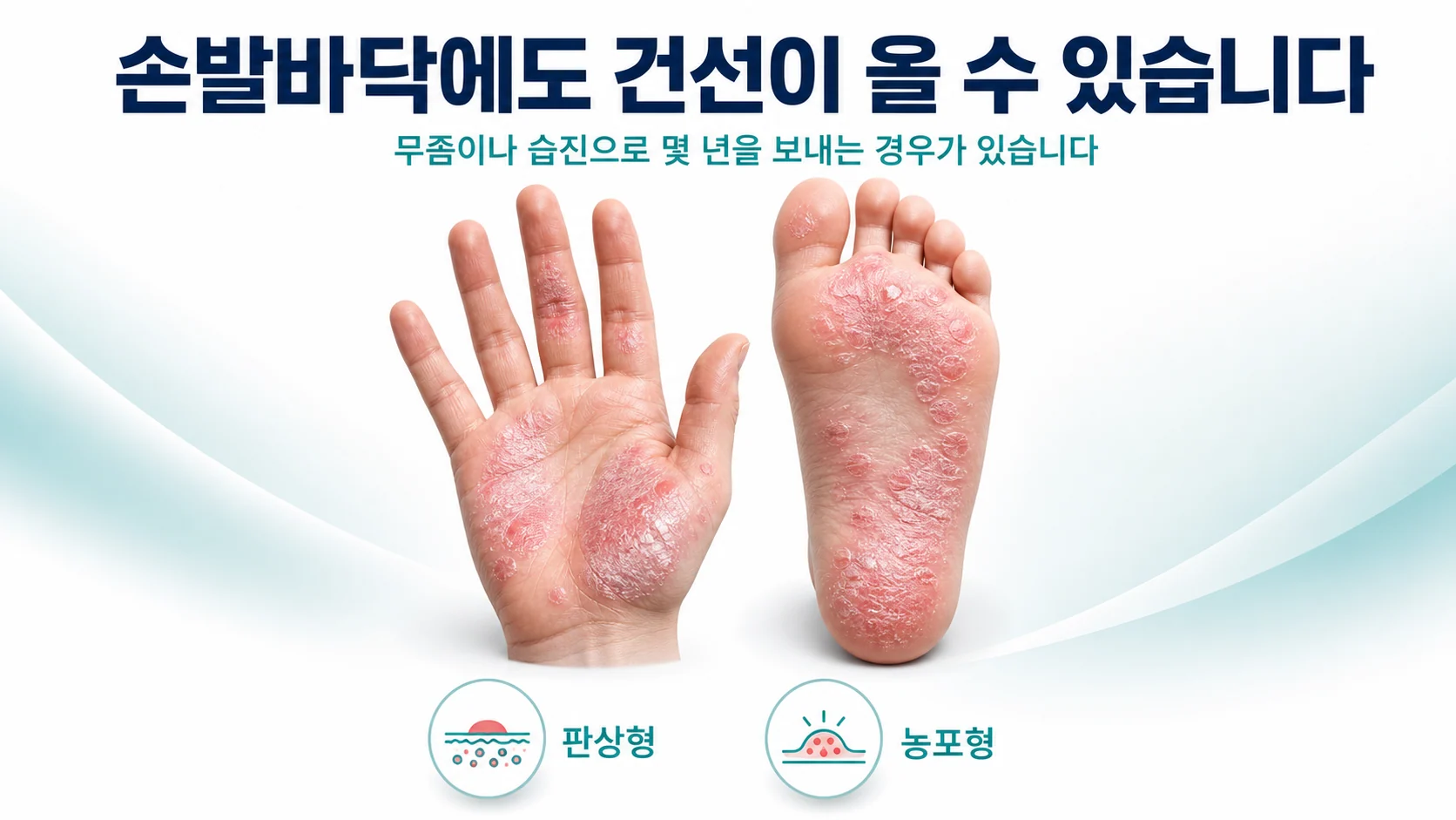 손발바닥에도 건선이 올 수 있습니다