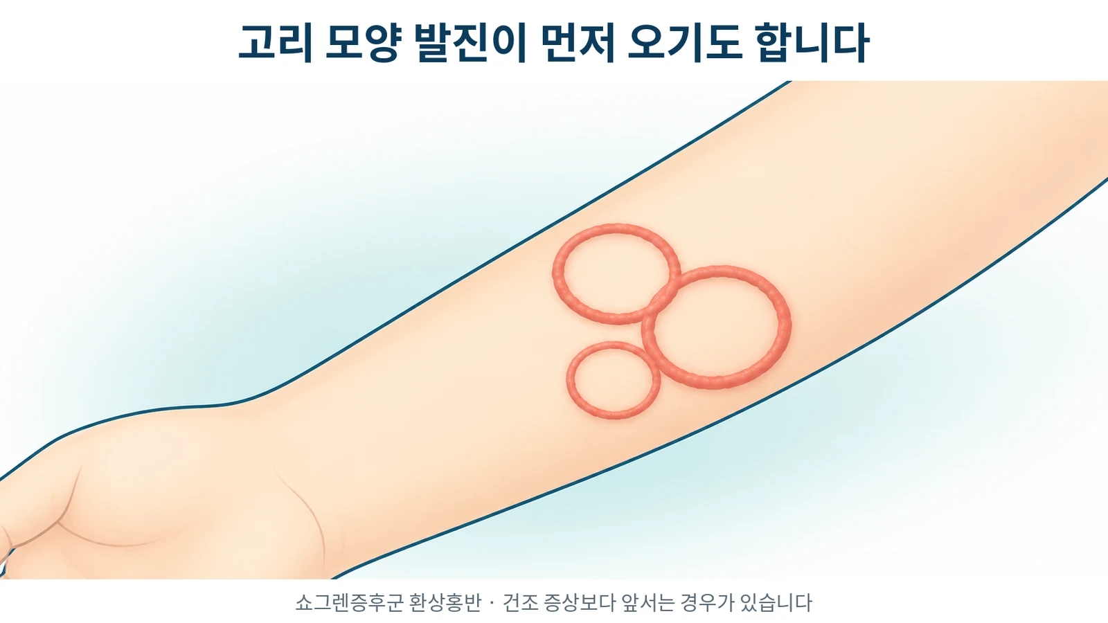 쇼그렌증후군 환상홍반, 고리 모양 발진이 먼저 오는 이유 — 카타야마 분류와 최근 지견