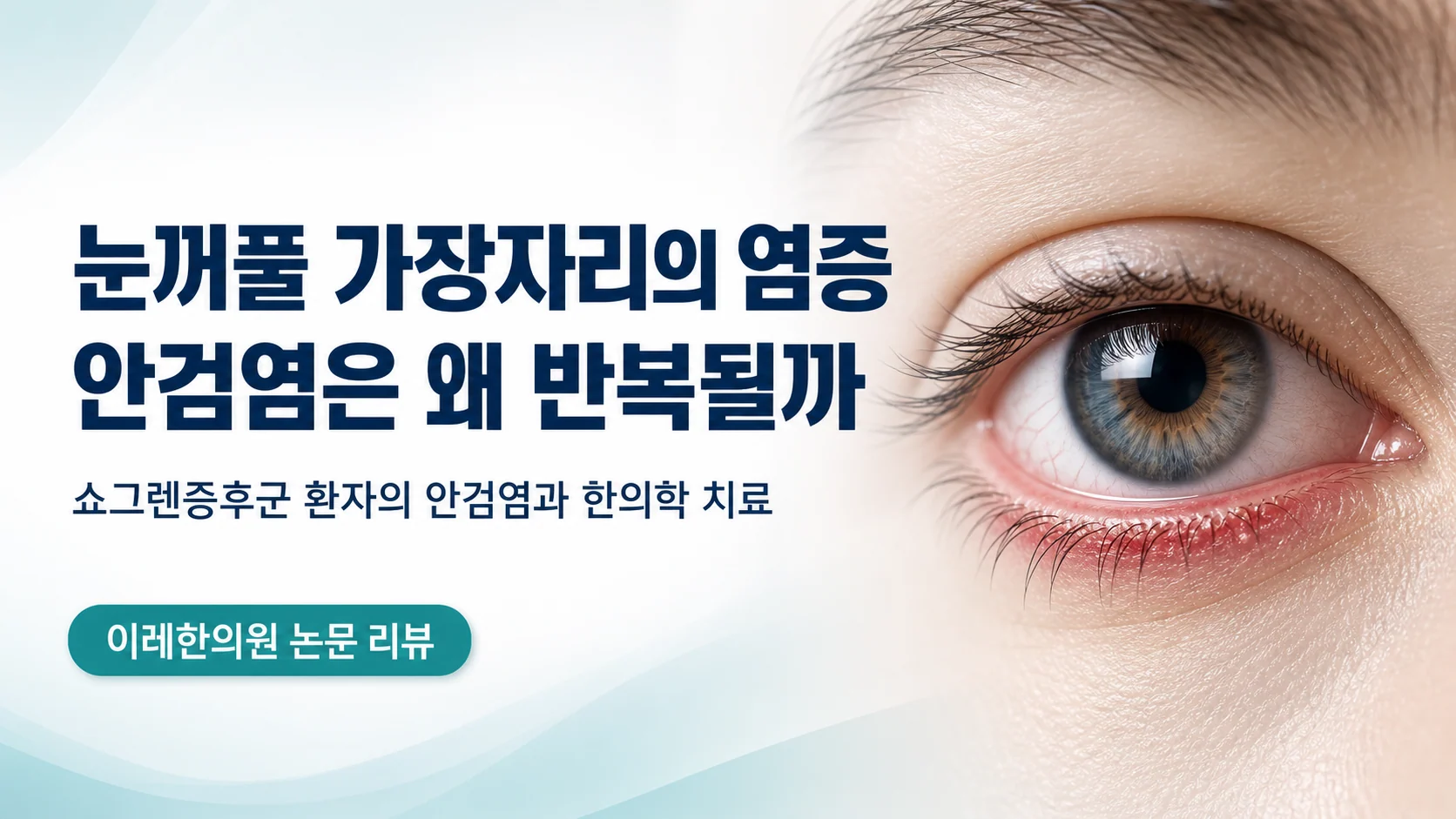 쇼그렌증후군에 발생하는 안검염의 특징과 한의학 치료