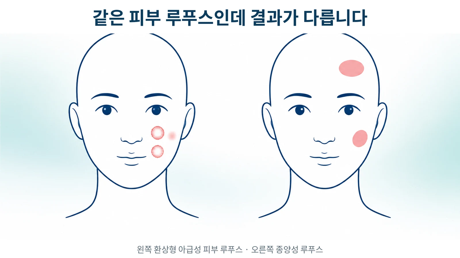 종양성 루푸스와 환상형 아급성 피부 루푸스, 무엇이 다른가 — 최근 지견