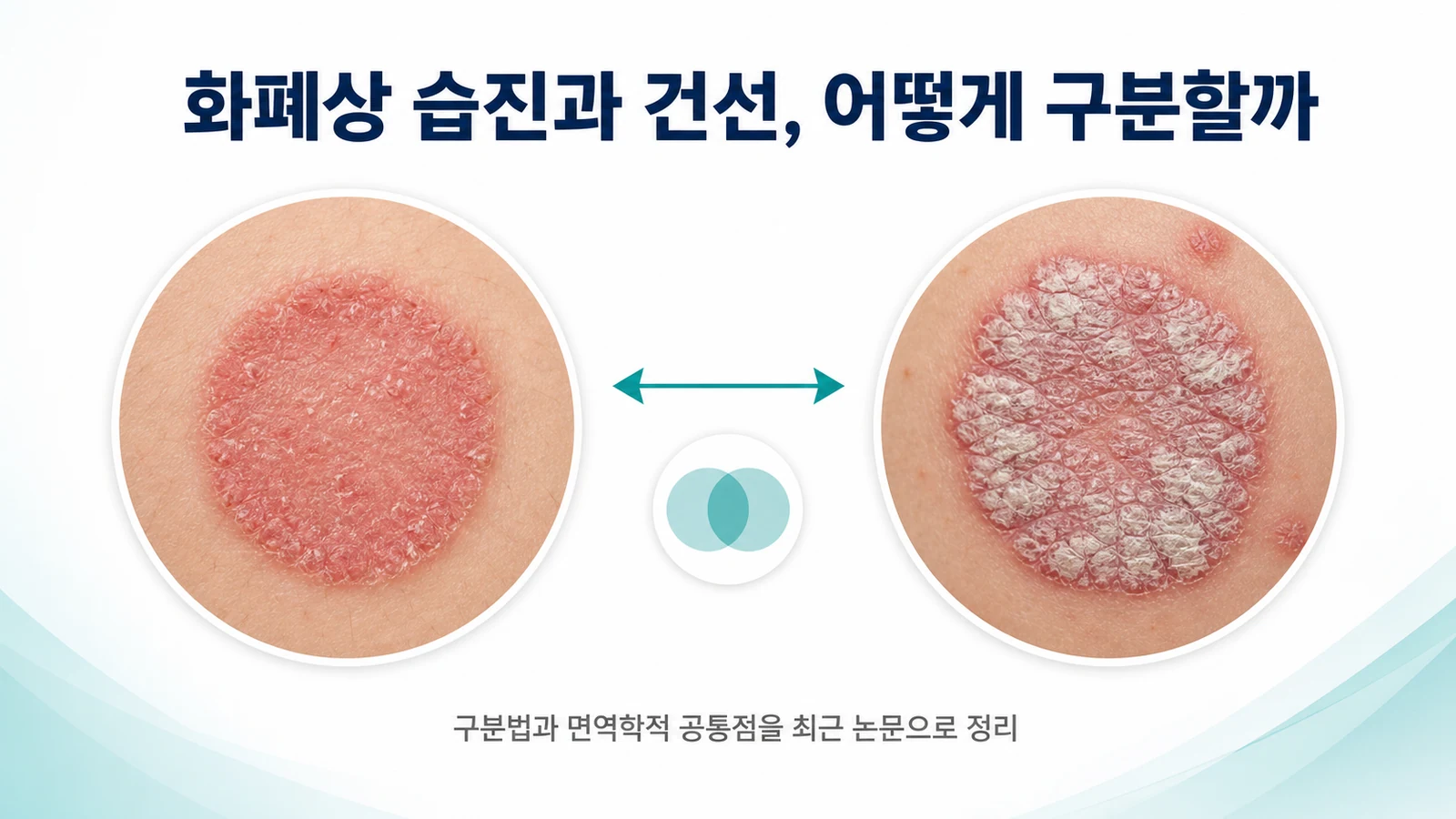 화폐상 습진과 건선, 어떻게 구분할까 — 면역학적 공통점과 개선 원리 | 인천 화폐상 습진 치료 한의원