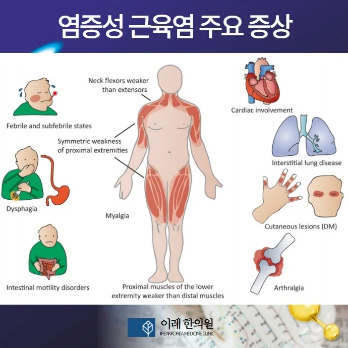 쇼그렌증후군과 염증성 근염 #2