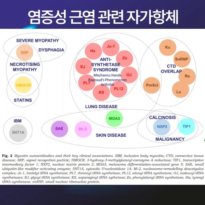쇼그렌증후군과 염증성 근염 #3