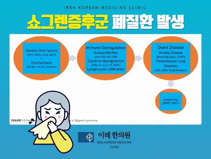 폐질환 발생 원인