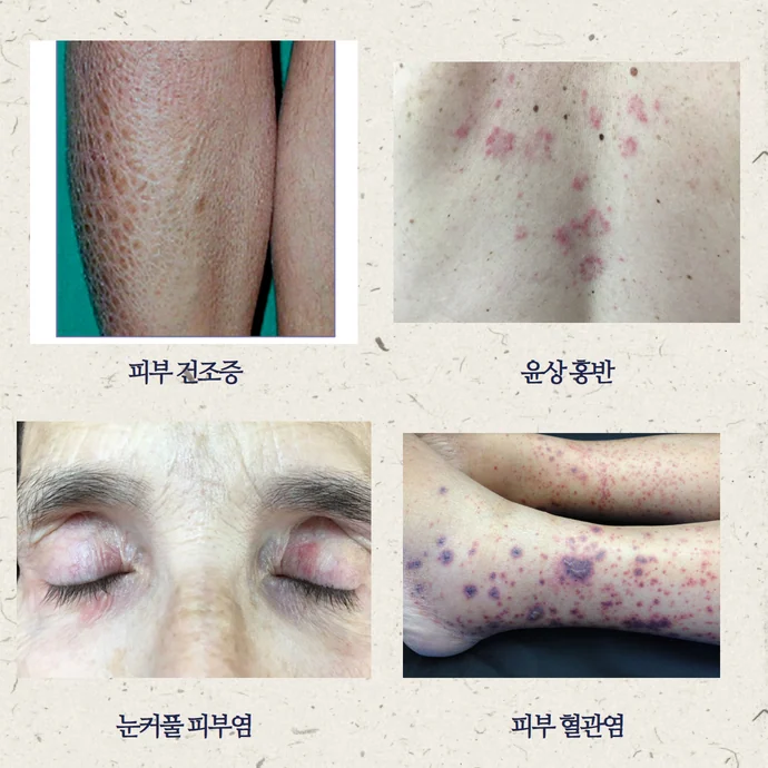 쇼그렌증후군의 피부 증상: 건조증, 혈관염, 자반증까지 #2