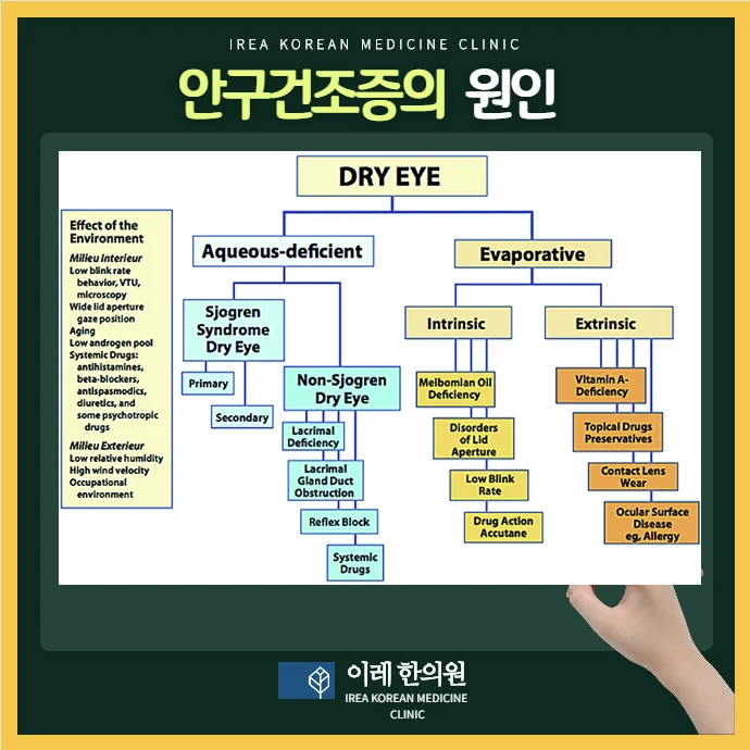 심한 안구건조증이 낫지 않는다면 쇼그렌증후군을 확인해보 #2