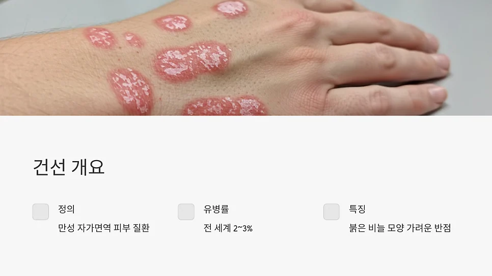 건선은 쇼그렌증후군 진단 위험을 높이는 자가면역질환입니 #3