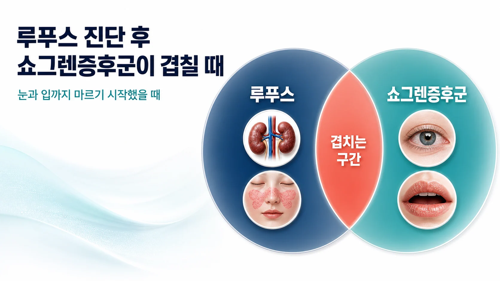 루푸스 진단 후 쇼그렌증후군, 눈과 입까지 함께 마르기 시작했을 때