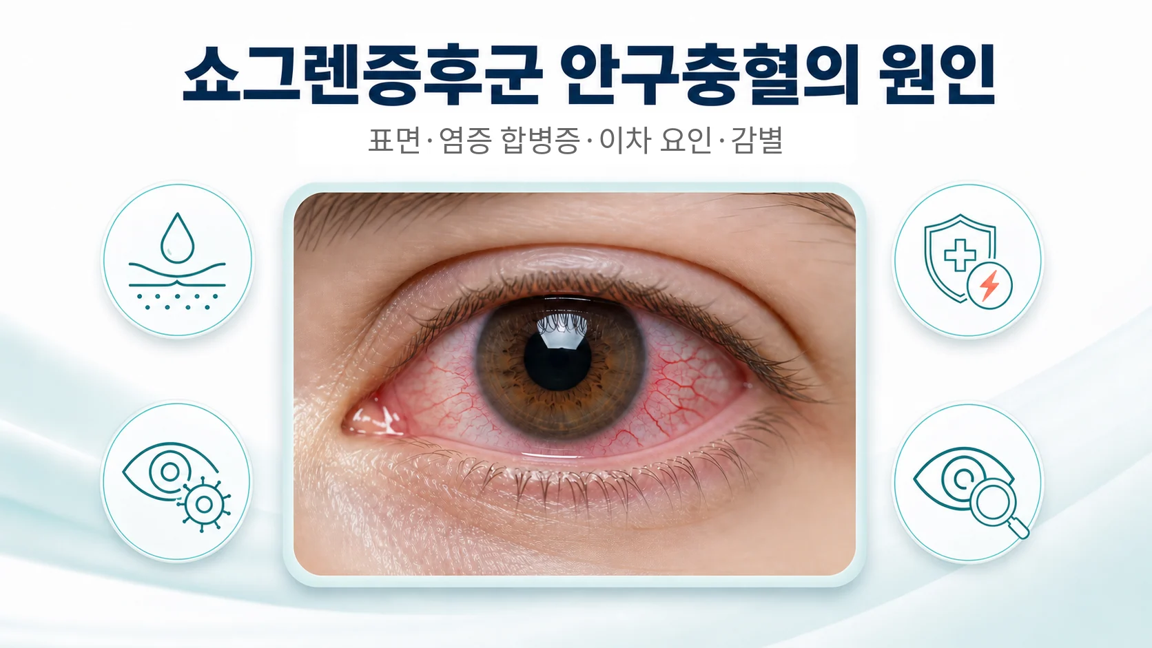 쇼그렌증후군 안구충혈의 원인