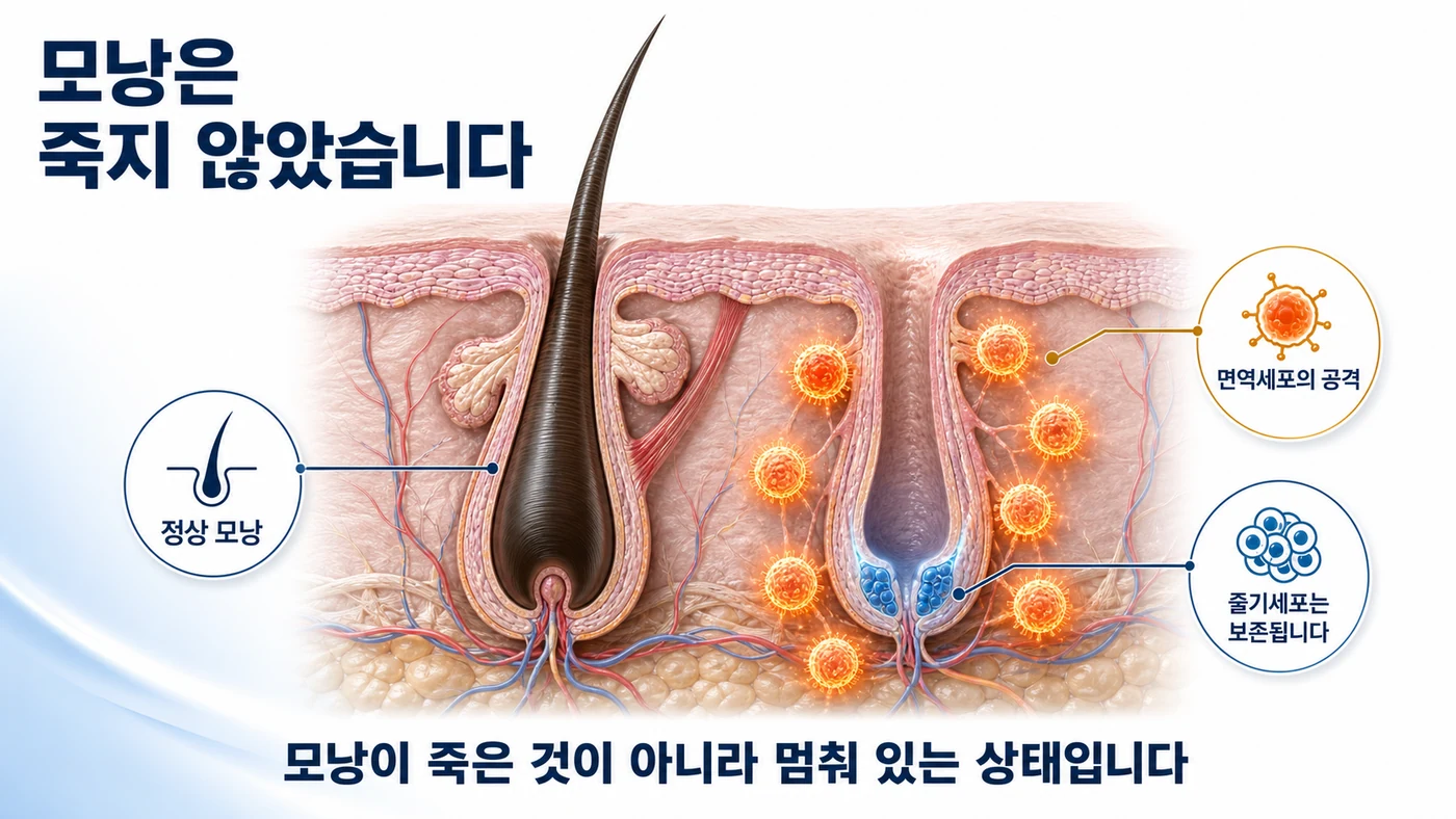 두피 단면에서 면역세포가 모낭을 공격하지만 모낭 줄기세포는 보존되는 기전