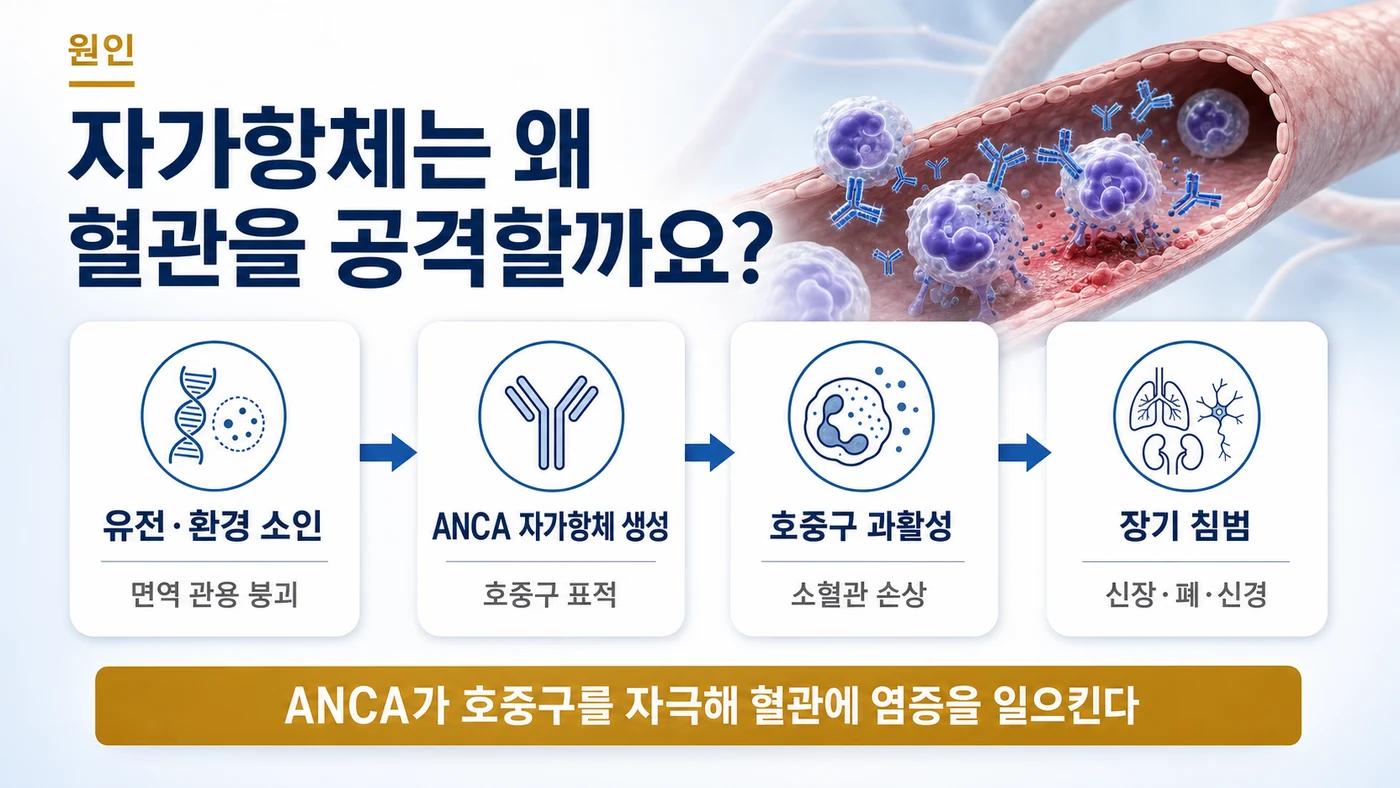 ANCA 연관 혈관염의 원인 — 유전·환경 소인 위에 ANCA 자가항체가 만들어져 호중구를 과도하게 활성화시키고 소혈관을 손상시켜 신장·폐·신경에 침범하는 흐름
