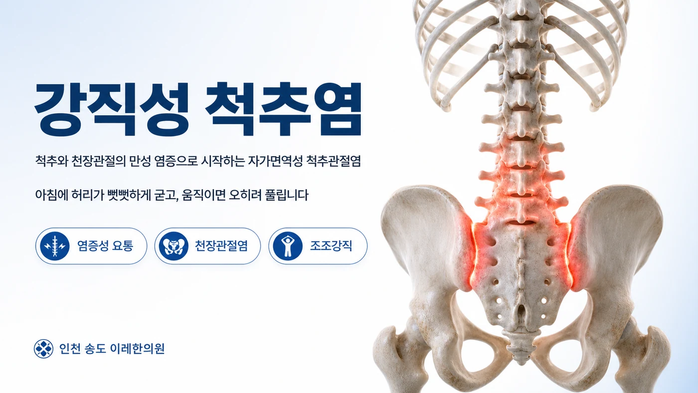 강직성 척추염 대표 이미지 — 천장관절과 요추에 염증이 표시된 척추·골반 도해, 염증성 요통과 조조강직이 특징인 자가면역성 척추관절염