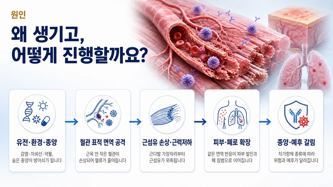 피부근염의 원인 — 유전·환경·종양이 방아쇠가 되어 근육 내 혈관을 표적으로 한 면역 공격이 일어나고 근섬유 손상, 피부·폐 확장, 예후 갈림으로 이어지는 과정