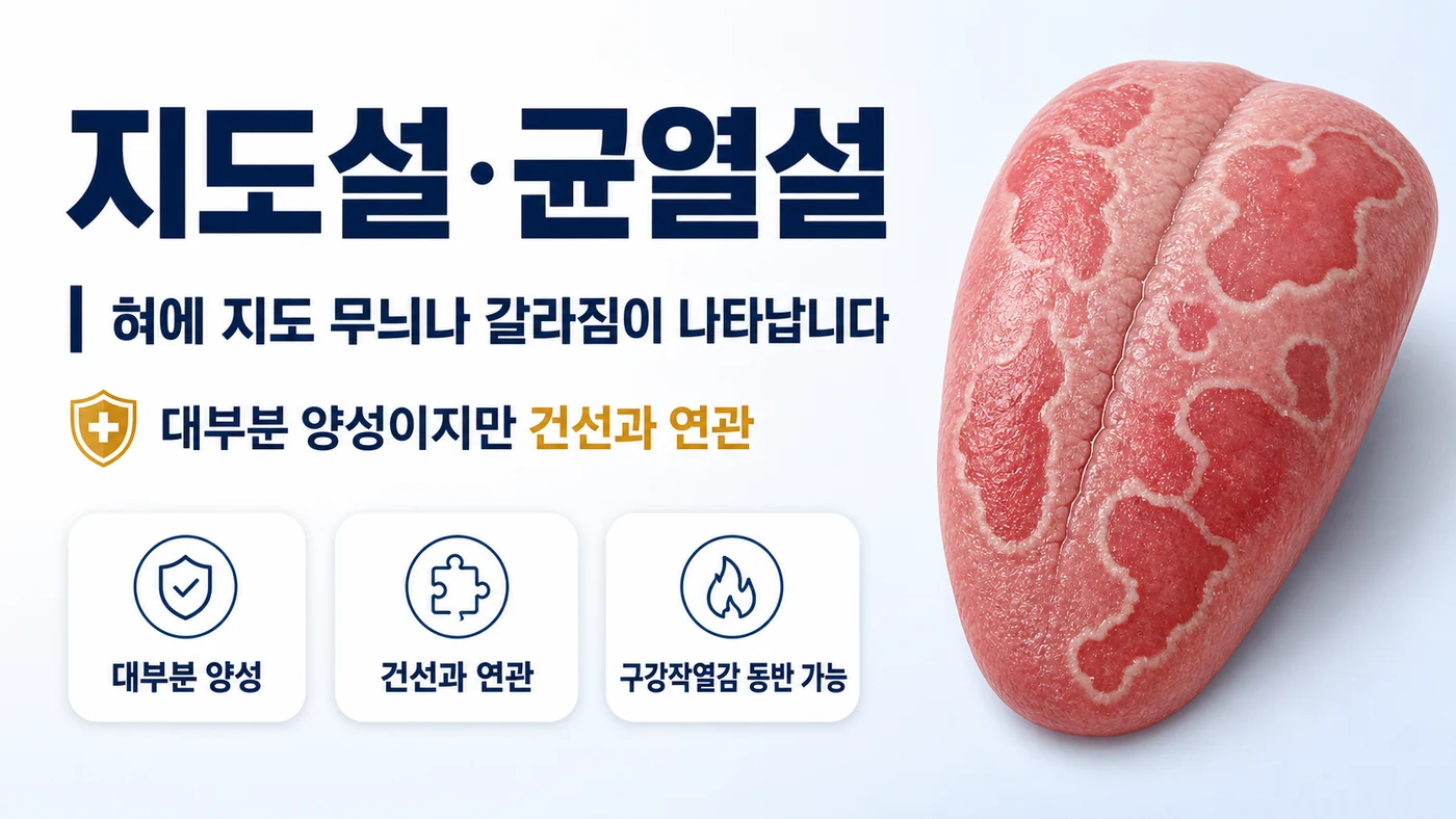 지도설·균열설 안내 — 혀 표면에 지도 무늬나 갈라짐이 나타나는 상태로 대부분 양성이지만 건선과 연관될 수 있음