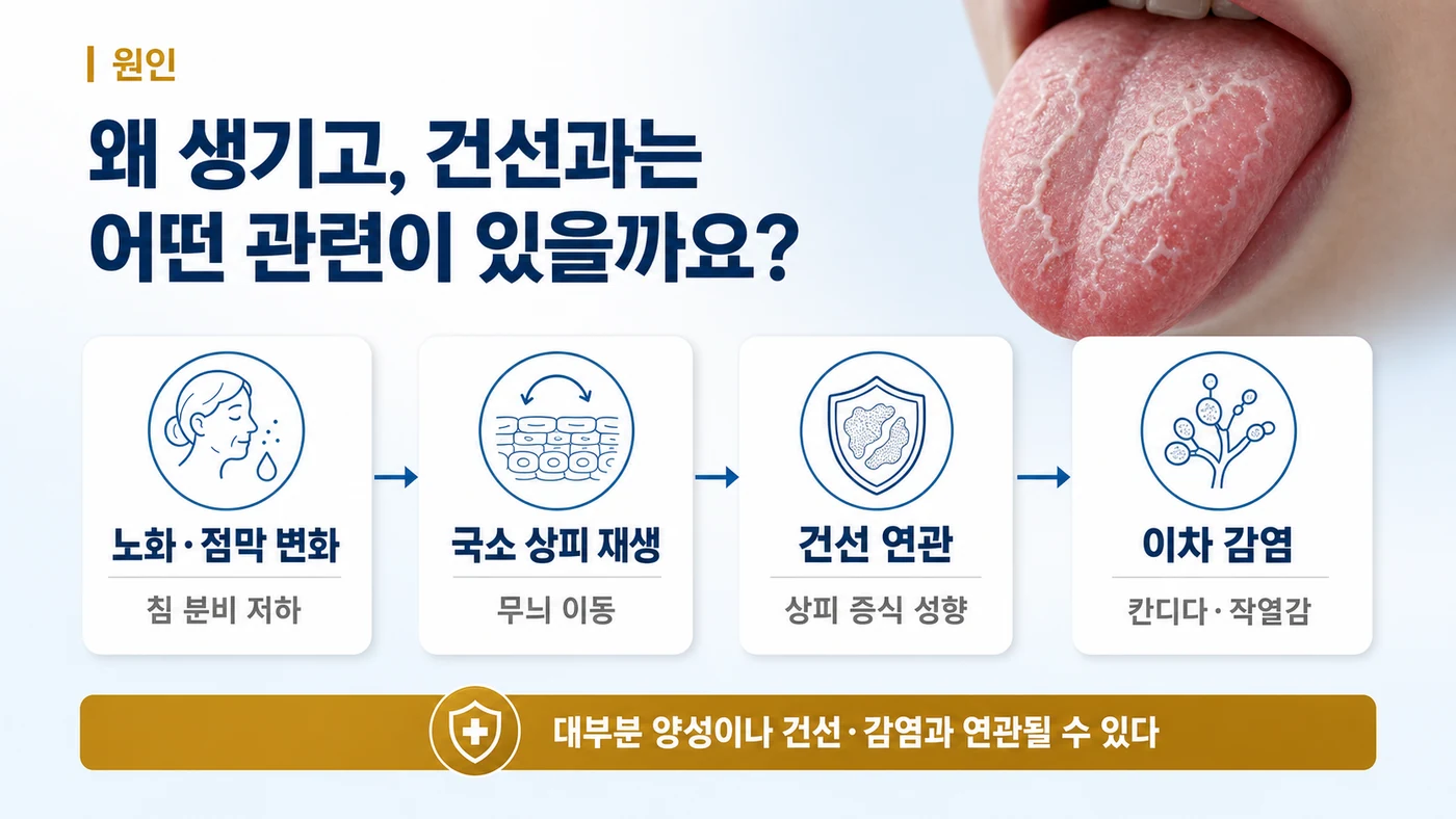 지도설·균열설의 원인 — 노화와 침 분비 저하, 혀 점막 상피의 국소 재생 이상을 배경으로 건선과 연관되며 균열에 칸디다 감염·작열감이 겹칠 수 있는 흐름