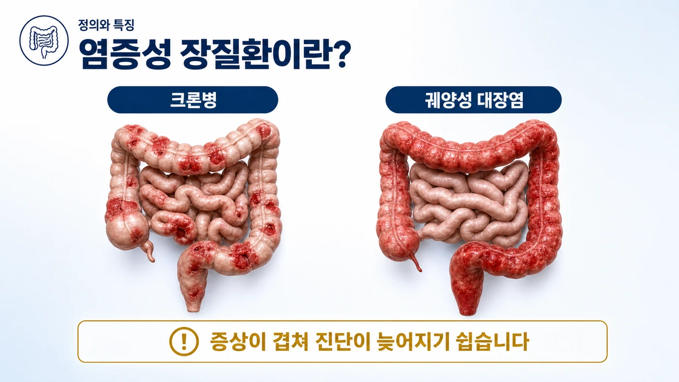 염증성 장질환이란 — 크론병은 소화관 여러 부위에 흩어진 염증, 궤양성 대장염은 대장에 연속된 염증으로 나타나며 증상이 겹쳐 진단이 늦어지기 쉬움