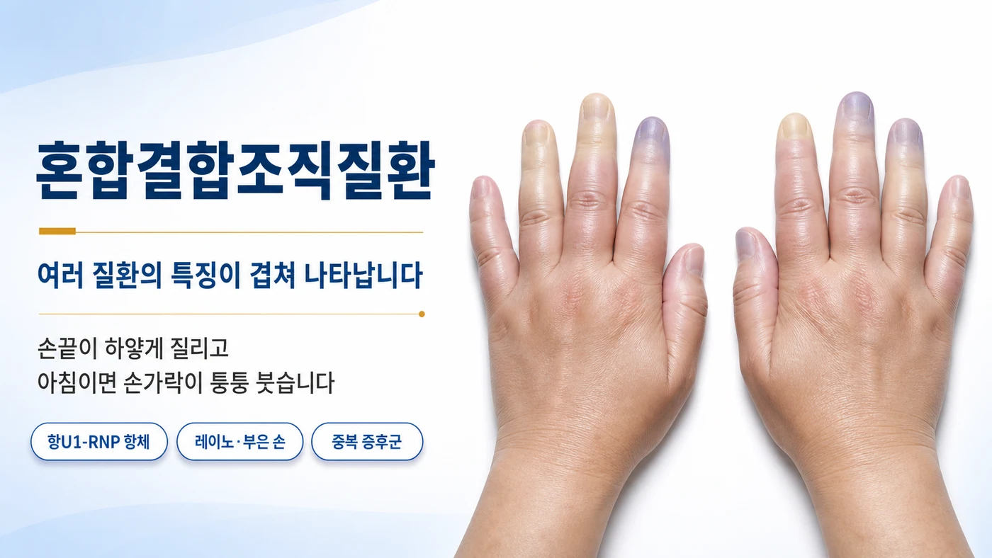 혼합결합조직질환 안내 — 손끝이 하얗게·파랗게 질리는 레이노 현상과 아침에 퉁퉁 붓는 손가락, 여러 질환의 특징이 겹쳐 나타나는 자가면역질환