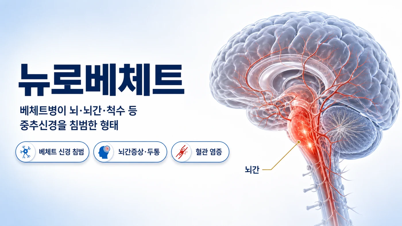 뉴로베체트 대표 이미지. 베체트병이 뇌와 뇌간, 척수 등 중추신경을 침범한 형태임을 뇌 단면과 염증이 표시된 뇌간으로 보여줍니다.