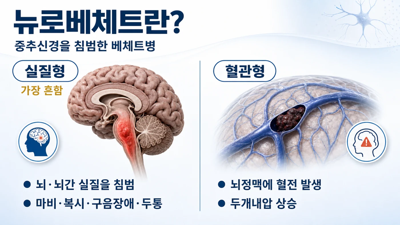 뉴로베체트의 두 유형 도해. 뇌와 뇌간 실질을 침범해 마비·복시·구음장애·두통이 나타나는 실질형과 뇌정맥에 혈전이 생겨 두개내압이 오르는 혈관형을 비교합니다.