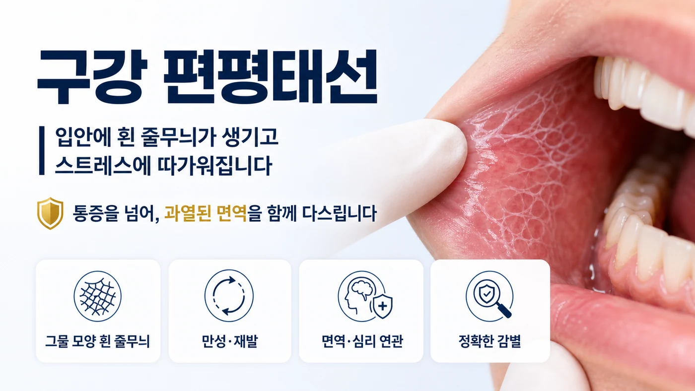 구강 편평태선 안내 — 입안 볼 안쪽에 그물 모양 흰 줄무늬가 생기고 스트레스에 따가워지는 만성 염증성 자가면역질환