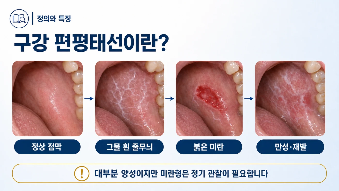 구강 편평태선이란 — 정상 점막에서 그물 모양 흰 줄무늬, 붉은 미란, 만성 재발로 이어지는 경과와 미란형의 정기 관찰 필요성